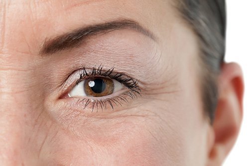 Wrinkles under eyes