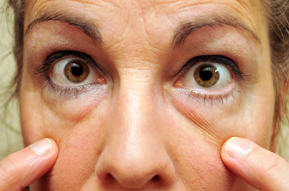 woman pointing out bags under eyes