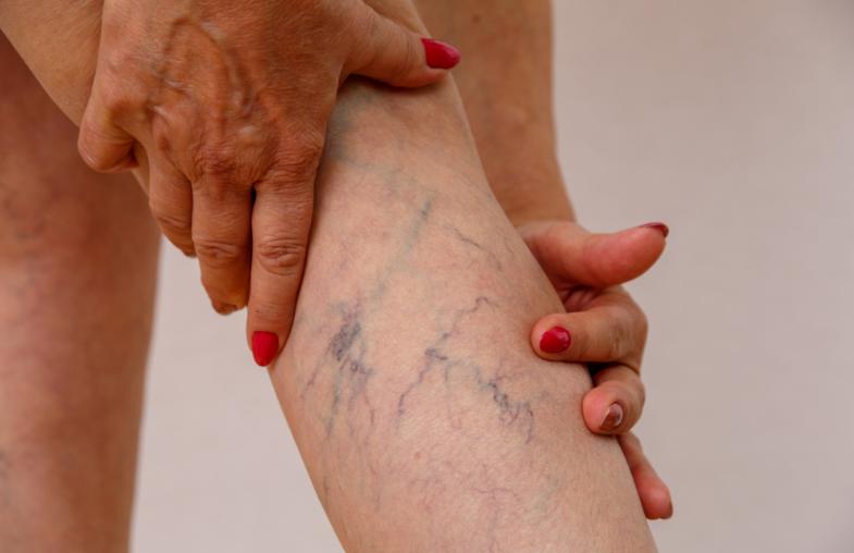 Does Massage Help Varicose Veins? Here's What The Doctors Say