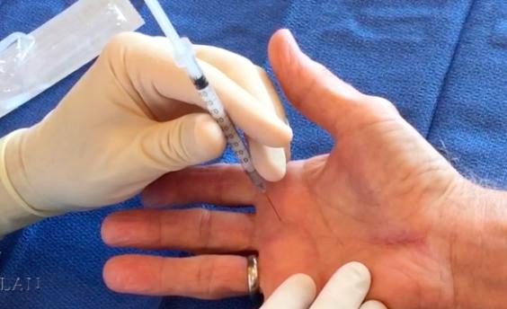 Trigger Finger Treatment: What To Know for a Complete Recovery